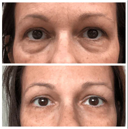 Skin Tightening + Eyebag Removal Cream ✨
