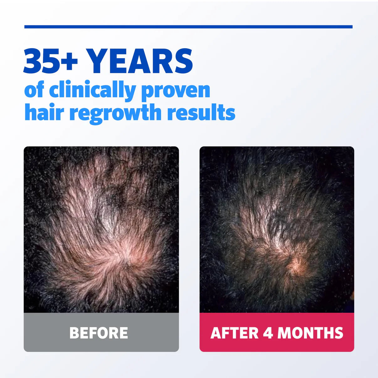 Minoxidil Hair growth Solution