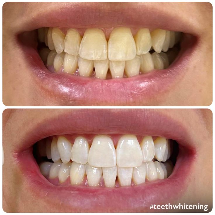 Dr Dent Teeth Whitening Strips (42 Strips)