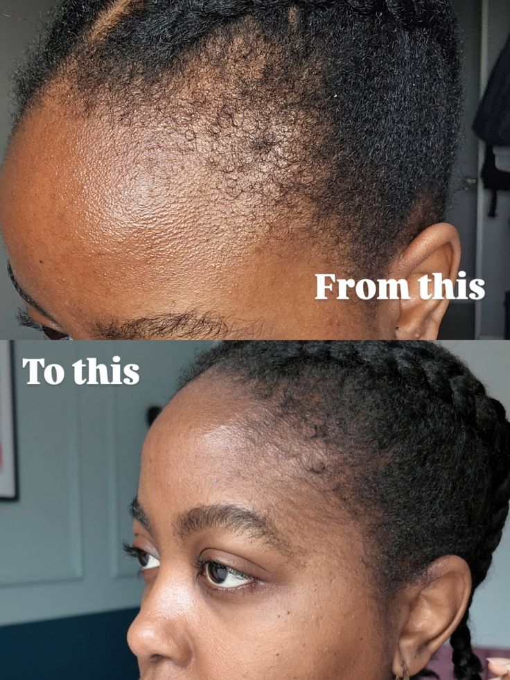 Minoxidil Hair growth Solution