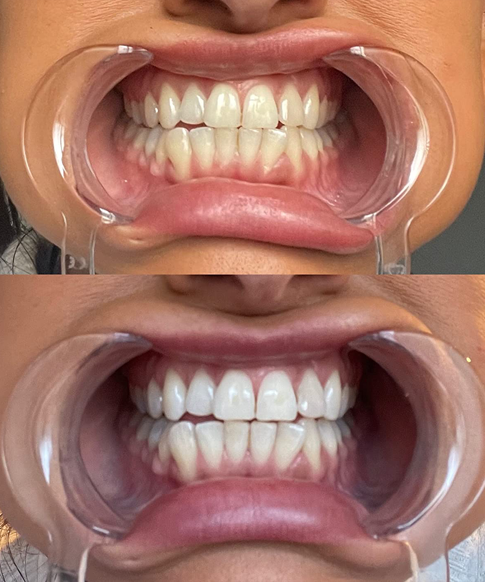 Dr Dent Teeth Whitening Strips (42 Strips)