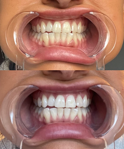 Dr Dent Teeth Whitening Strips (42 Strips)
