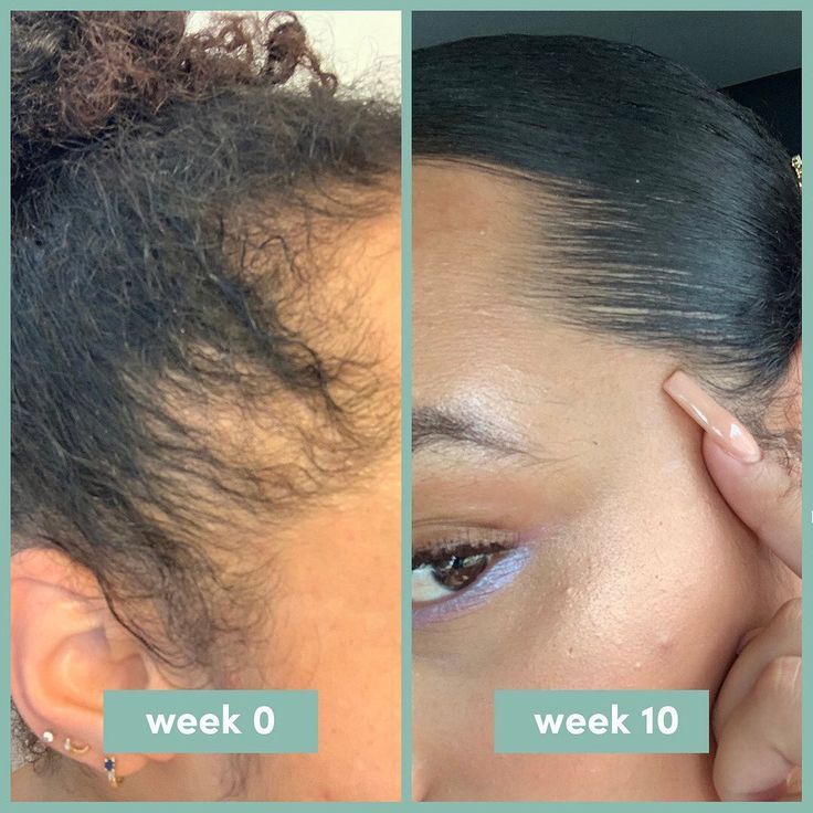 Minoxidil Hair growth Solution