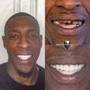 Before and after comparison of a person's smile with dental work, featuring temporary teeth repair