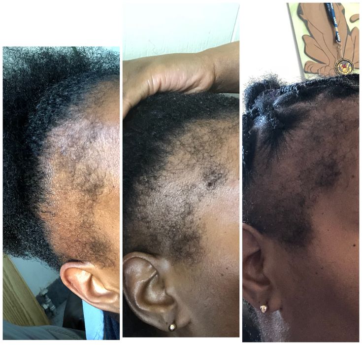 Minoxidil Hair growth Solution
