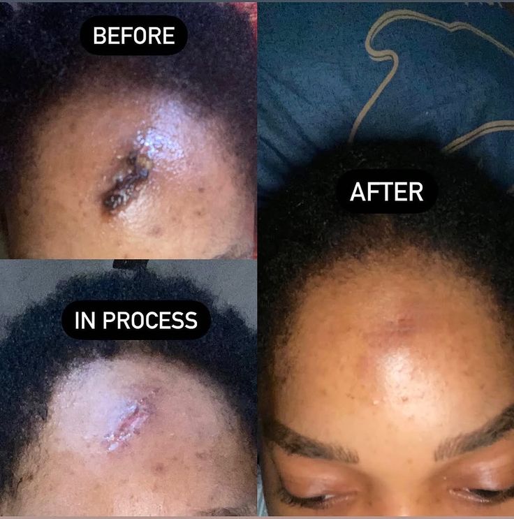 Advanced  Scar Removal Gel