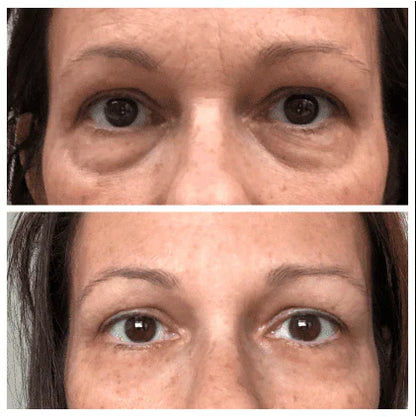 Skin Tightening + Eyebag Removal Cream ✨