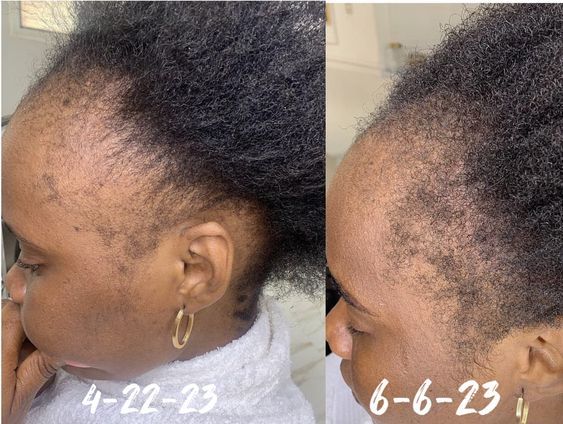 Minoxidil Hair growth Solution