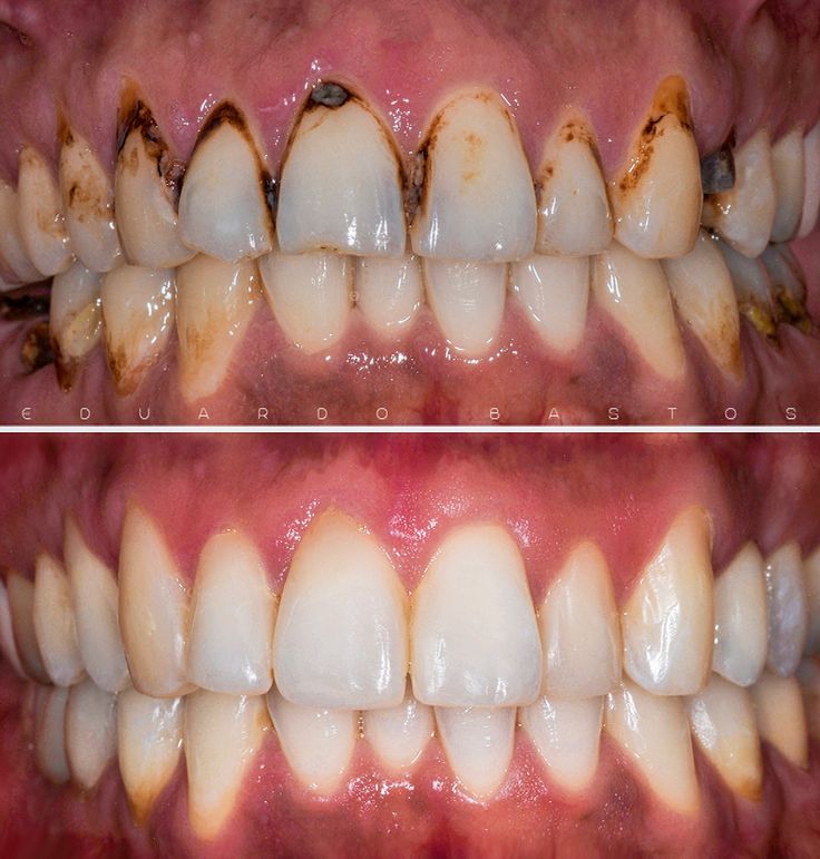 Dr Dent Teeth Whitening Strips (42 Strips)