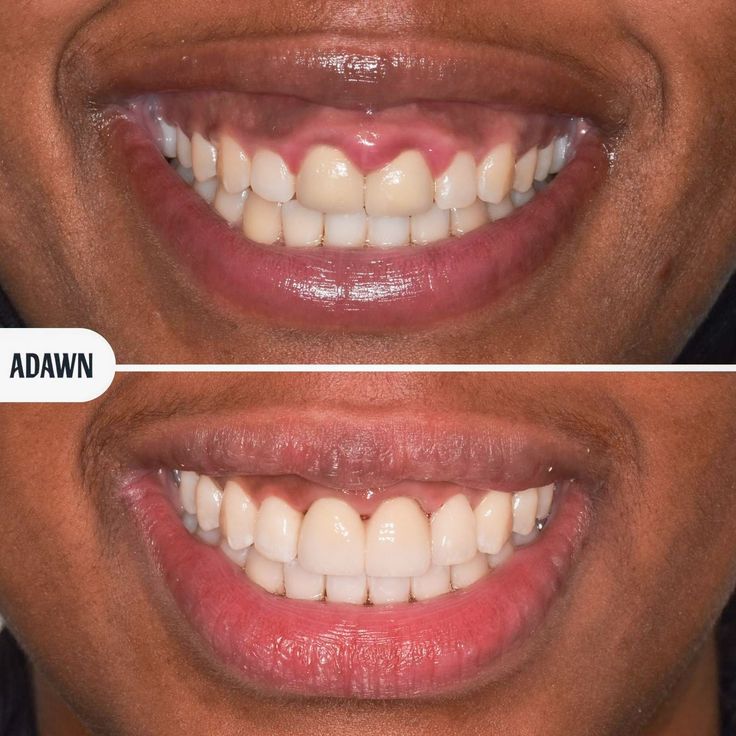 Regain Your Smile and Confidence Today!