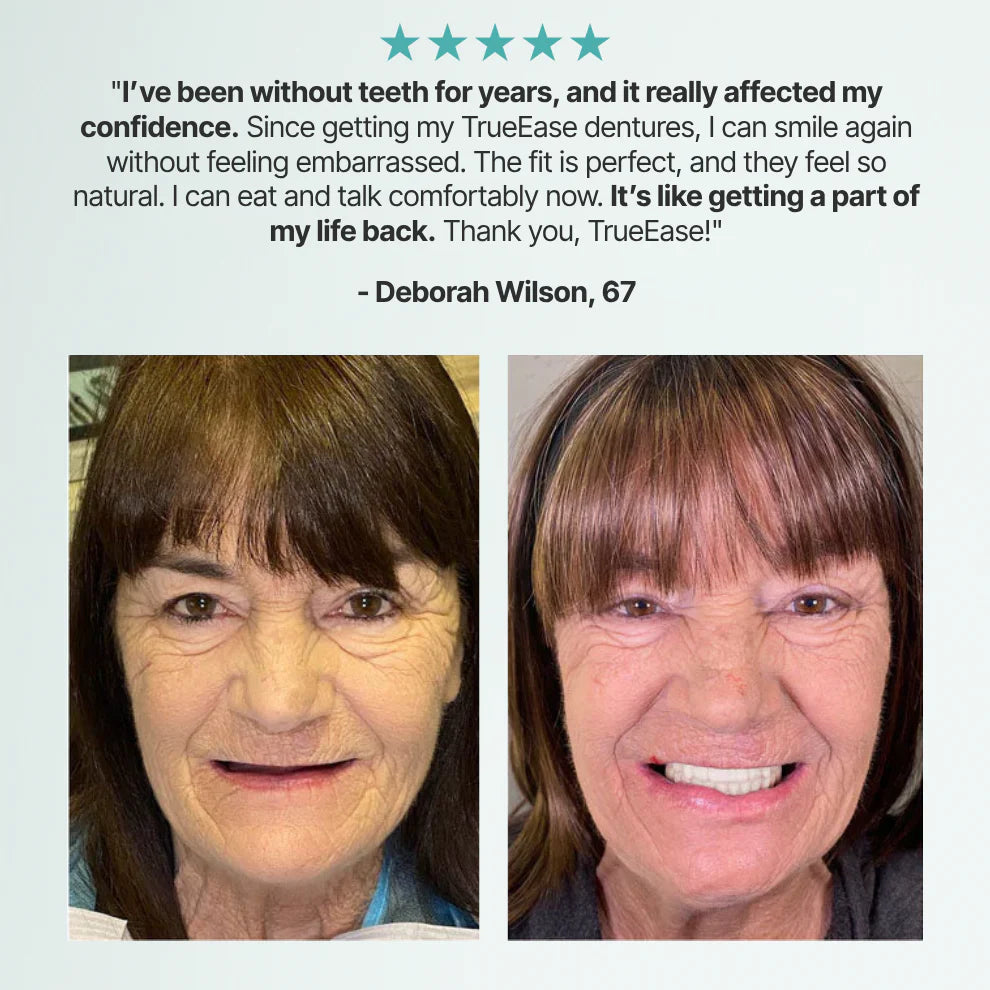 TrueEase™ Custom-Fit Full Functional Dentures